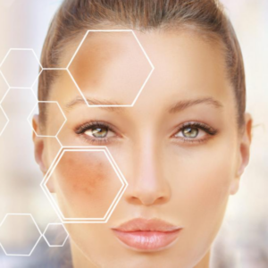 Nano Fractional Radiofrequency Skin Resurfacing