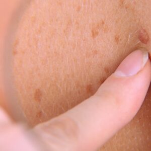 Skin Tag Removal